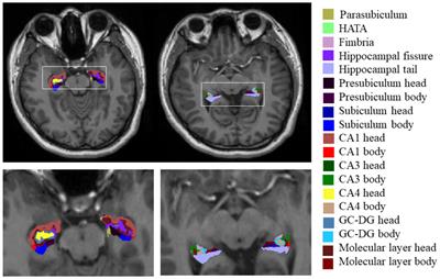 Atrophy patterns in hippocampal subregions and their relationship with cognitive function in fibromyalgia patients with mild cognitive impairment